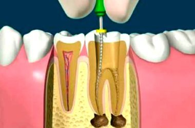 Endodoncia Klinik Visión